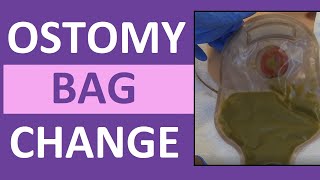 Ostomy Bag Pouch Change | Ostomy Care Nursing | Colostomy, Ileostomy Bag  Change