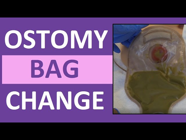 Know all about Stoma or Ostomy Care - Manipal Hospitals