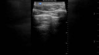 Lung Sliding | Clinical Image