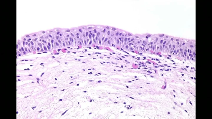 Diagnosis, Staging, and Grading of Urothelial Carc...
