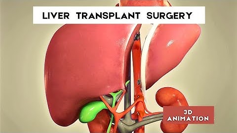 liver transplant surgery procedure - 3D Animation