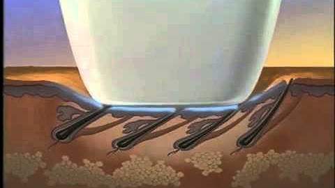 Lumenis - LightSheer ET.mp4