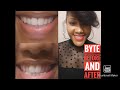 Byte Aligners!! My Blessing!! Discount Code Below!!