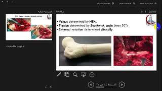 Imhauser Osteotomy Prof Tarek Han