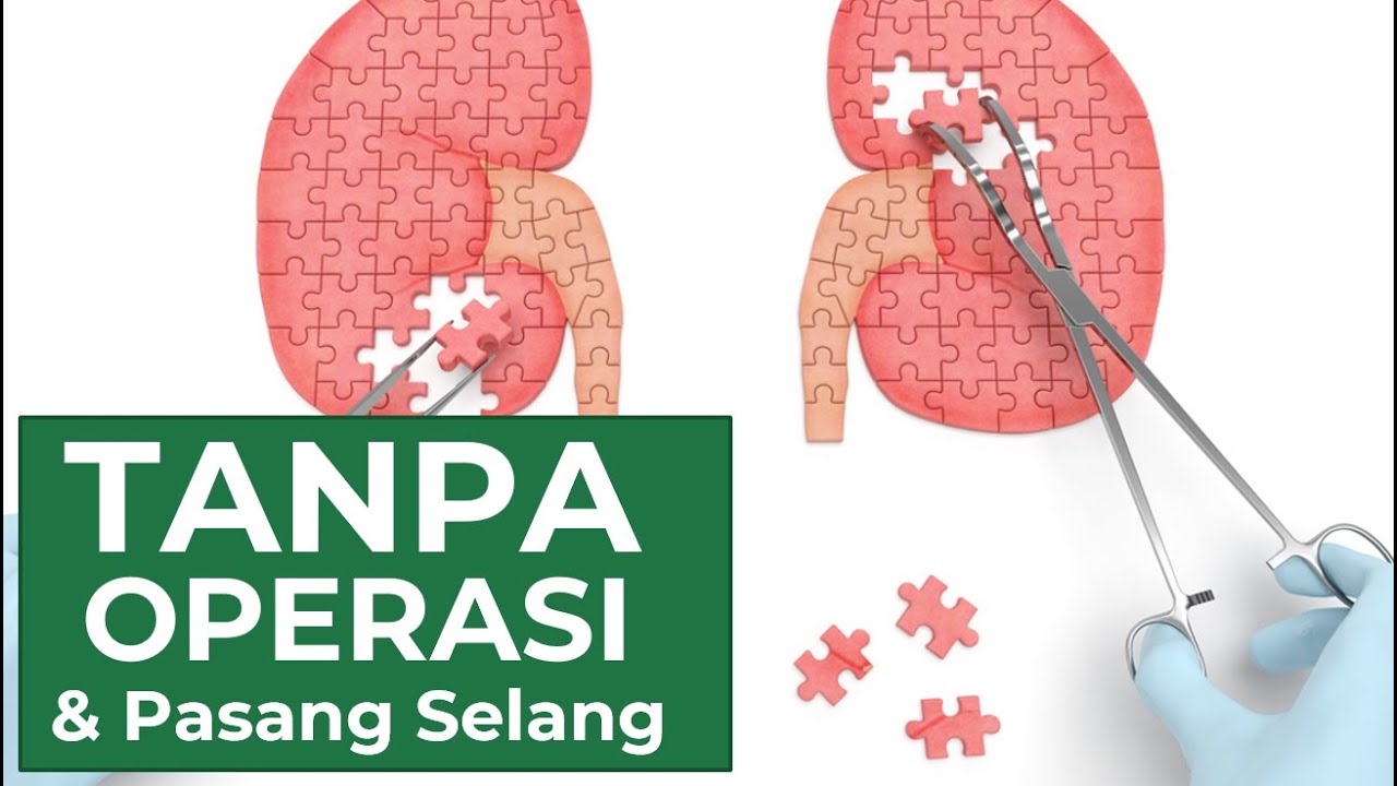 Cara Mengobati Pembengkakan Ginjal Secara Alami (2021) - 0852 1158 8535