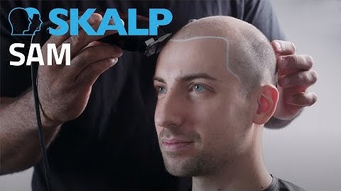 Scalp Micropigmentation by Skalp® Sam documents his whole journey.