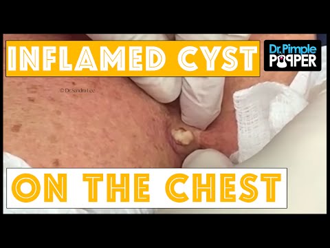 Inflamed Cyst Between The Breasts, Punched And Squeezed.