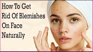 How to get rid of blemishes & acne scars naturally || Sparkle's Beauty