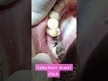 healing abutment,dental implant, #dentist #anbu laser dental clinic #smiledesigndental #smileenhanc