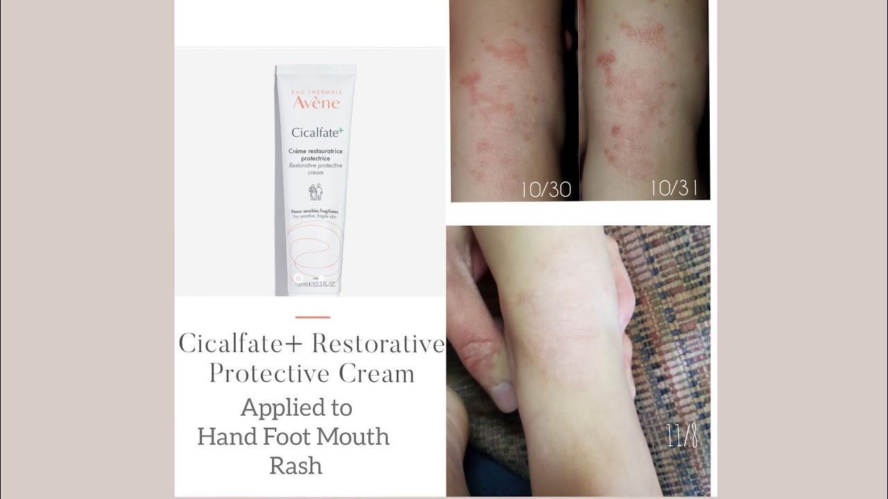 Avène Cicalfate Restorative Protective Cream used on Hand Foot Mouth Rash-  cleared FAST! 