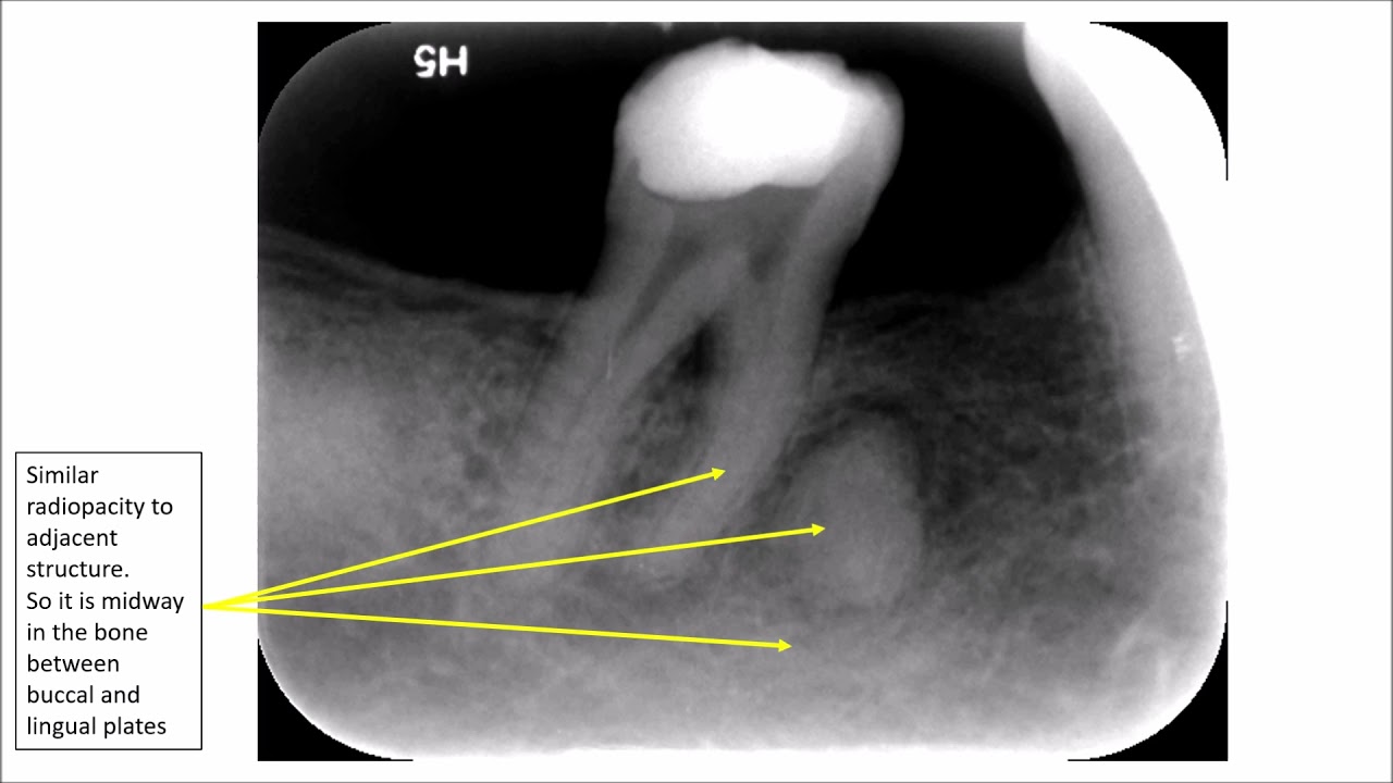 How to Locate the Position of Structures in 2D Radiographs 2 - YouTube