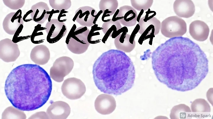 Acute Myeloid Leukemia (AML) w/ Monocytic Differentiation (formerly AMML) with Blasts & Promonocytes - DayDayNews