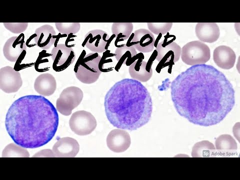 Acute Myeloid Leukemia (AML) w/ Monocytic Differentiation (formerly AMML) with Blasts & Promonocytes