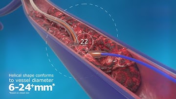 ClotHunter™ paired with ZelanteDVT™ Thrombectomy Catheter Enhancement