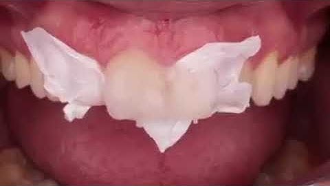 #Tag your friends Flowable Injection Technique      Faculty Of Dentistry