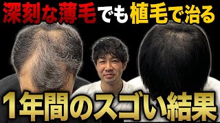 【衝撃の変身】深刻な薄毛だった30代男性が植毛して1年で別人に大変身！