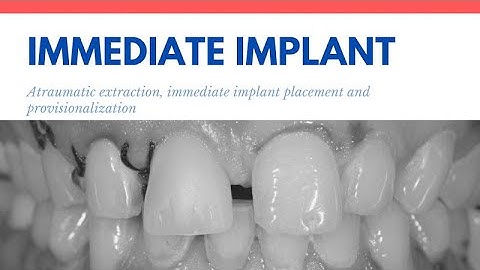 Immediate Implant with Screw retained temporary crown.