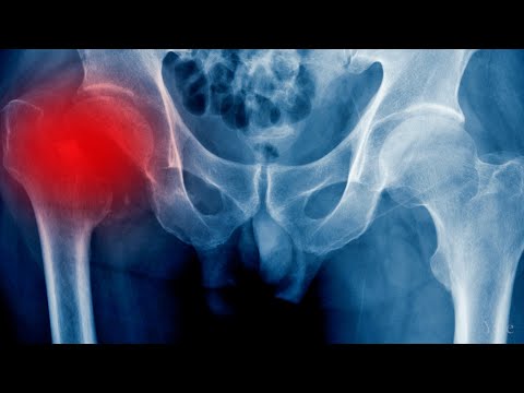 Video: Kas ārstē kaulu avaskulāro nekrozi?