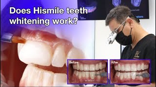 Hismile PAP+ teeth whitening results by Prof. Laurie Walsh