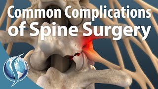 Common Complications of Spine Surgery
