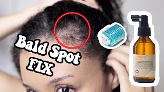 How To Get Rid Of Bald Spots + DEMO