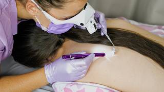 ASMR Back Pimples Extraction, Body Exam, Full Scalp Check, Head Inspection on @EleynaASMR screenshot 1