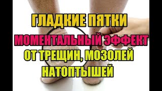 ПЯТКИ КАК У МЛАДЕНЦА!  10 МИНУТ и НАТОПТЫШЕЙ и МОЗОЛЕЙ как не бывало.