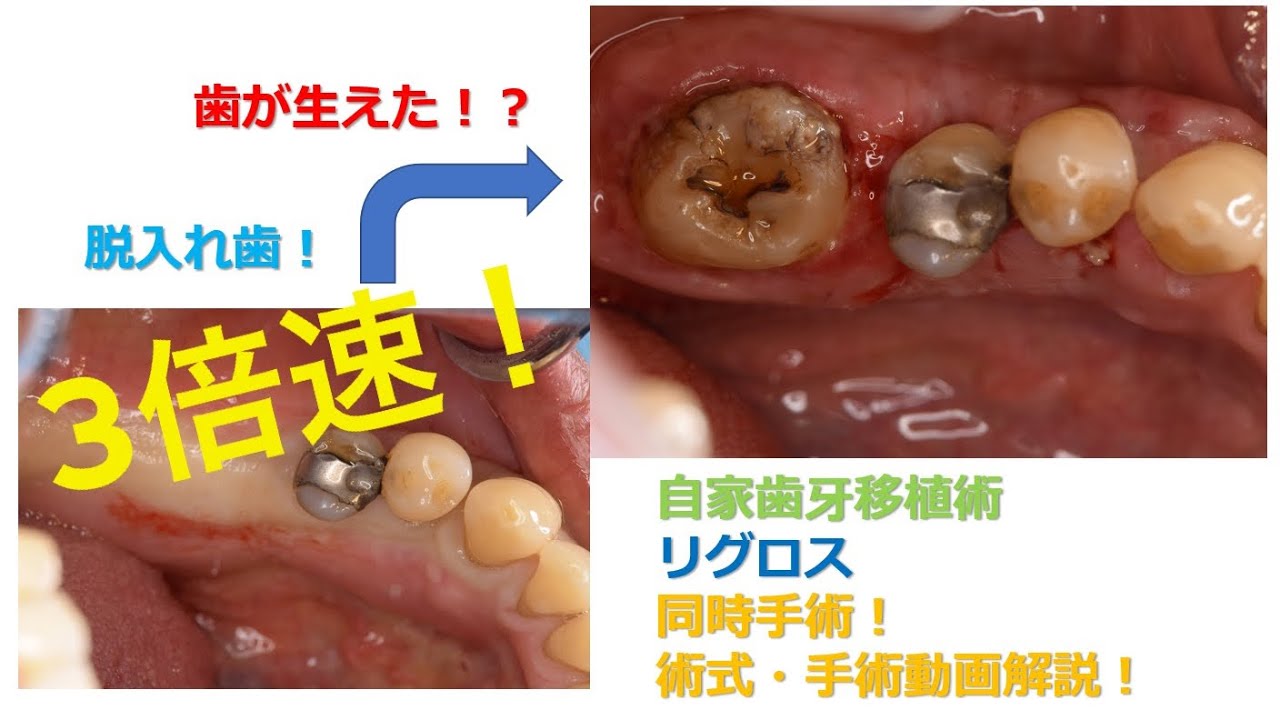 ほぼフル3倍速！どうする欠損歯！？～自家歯牙移植、リグロス、歯肉