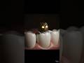 दांतों का सबसे बड़ा दुश्मन: यह 'वायरस' आपको बर्बाद कर देगा! #dentist #viral#trending #shortvideo