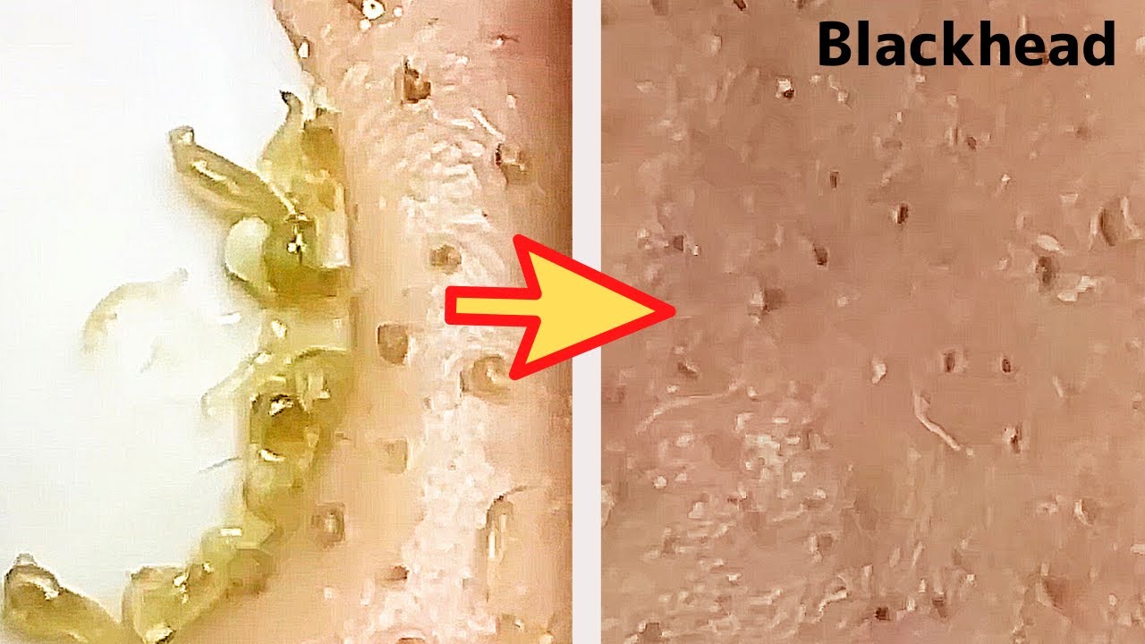 角栓除去 ニッパーでとる 大量のニキビを芯出しするのって気持ちいい Blackhead Removal Show ニキビ動画まとめ