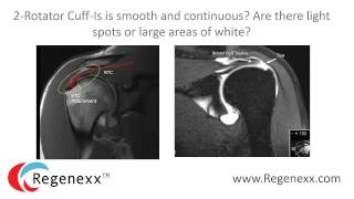 How to read your shoulder MRI with Dr. Centeno of Regenexx