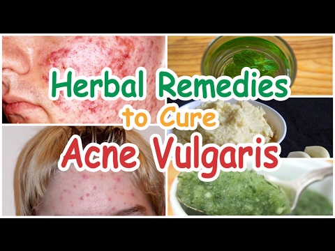 Best Herbal Remedies To Get Rid Of Acne Vulgaris | Natural Pimples Treatment