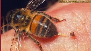 علاج الأمراض المستعصية والخطيرة بلسعات النحل أو سم النحل