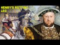 Everything You Didn&#39;t Need To Know About Henry VIII&#39;s Ulcerated Leg