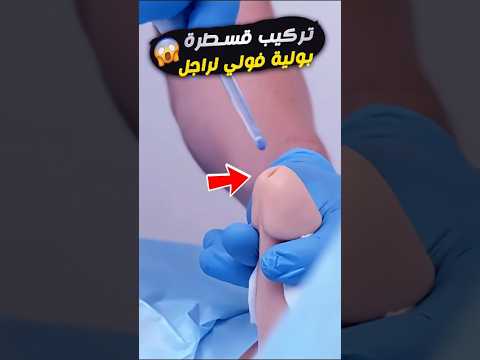 تركيب قسطرة بولية فولي للذكور