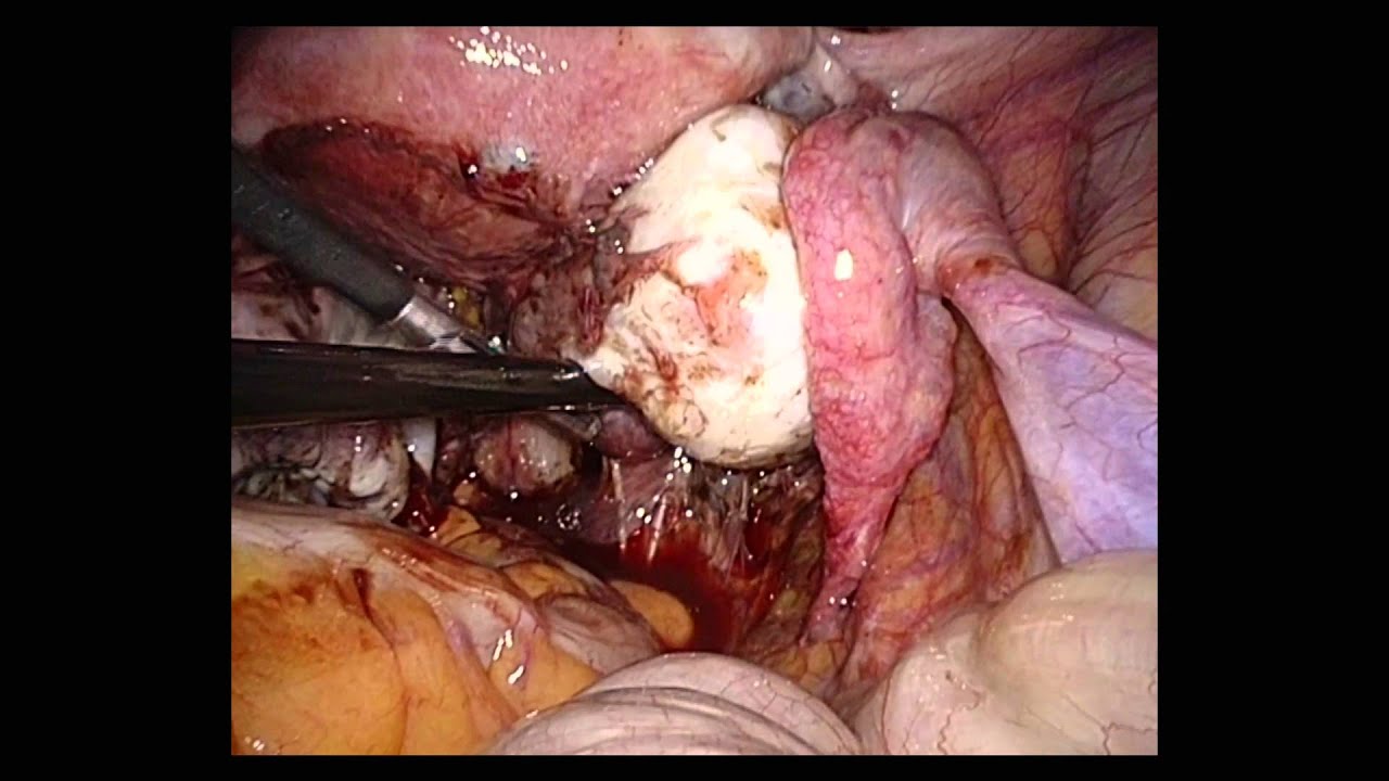Chocolate cyst - YouTube