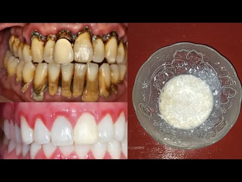 Video: Hutchinsonovi Zubi: Slike, Uzroci, Liječenje, Prevencija