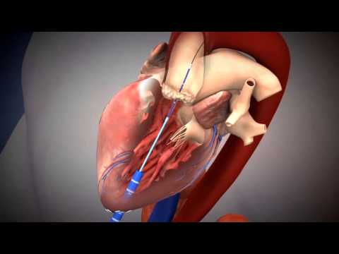 SAPIEN TAVR Deployment Using Transapical Approach
