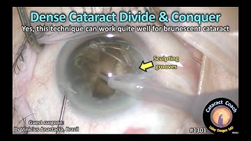 CataractCoach 1301: dense cataract divide and conquer technique