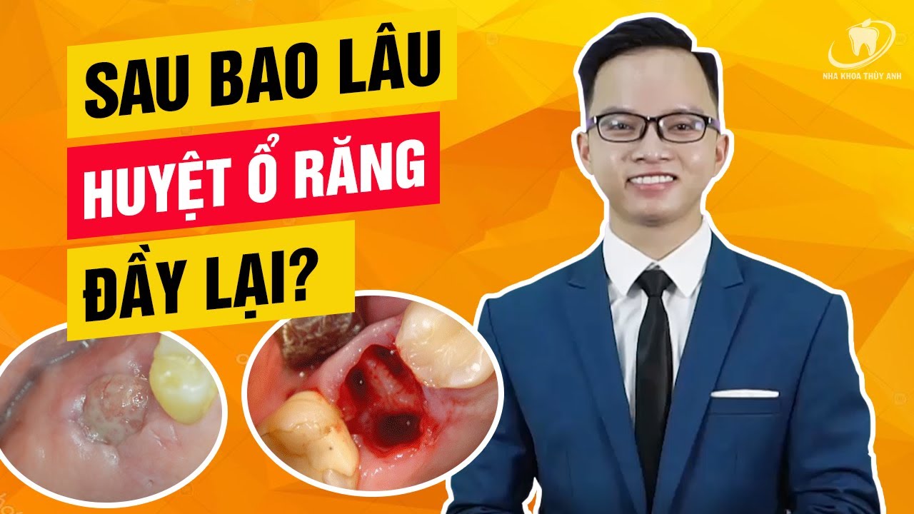 Outline Video Sau nhổ răng bao lâu thì HUYỆT Ổ RĂNG đầy lại – Diễn biến lành thương sau nhổ răng