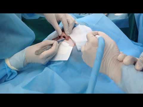 Bác Sĩ Trần Phương: Livestream cận cảnh phẫu thuật nâng mũi cấu trúc