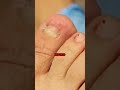 Removing damaged nail helps new nails to grow better!! 🦶