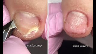 Most Satisfying Pedicure and Ingrown Nail Treatment #2