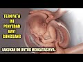 Hal yang Bisa Menyebabkan Bayi Sungsang dan Cara Mengatasinya