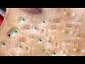 Blackhead removal | Blackhead extraction | #blackheads