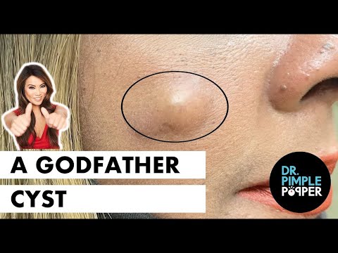 How To Burst A Bartholin Cyst At Home - The GodFather Cyst