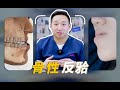 针对骨性地包天治疗 正畸掩饰性治疗vs正畸正颌联合治疗 针对骨性地包天治疗 正畸掩饰性治疗vs正畸正颌联合治疗