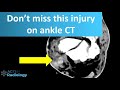 Peroneal tendon injury on CT