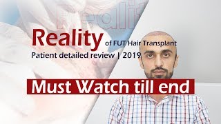 Reality Of Fut Strip Hair Transplant - Patient Detailed Review