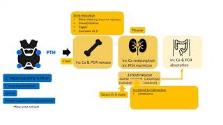 Hypercalcemia - Diagnosis and Management
